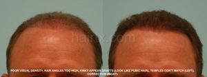Balding Man Before and After Corrective Hair Transplants