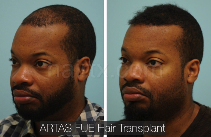 Robotic FUE Dallas | ARTAS Robotic Hair Transplant Plano, Tx