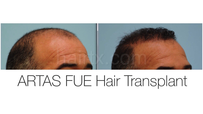 Follicular Unit Extraction Dallas | FUE Hair Transplant ...
