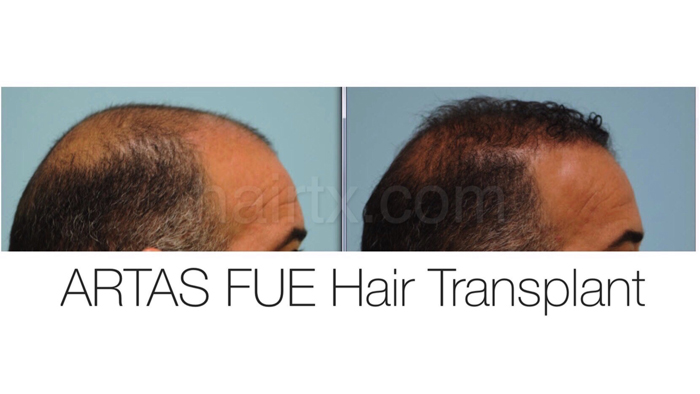 Robotic FUE Dallas | ARTAS Robotic Hair Transplant Plano, Tx Robotic FUE Dallas | ARTAS Robotic Hair Transplant Plano, Tx