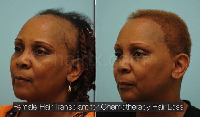 Female Hair Transplantation Dallas | Hair Transplant Procedures Plano, Tx
