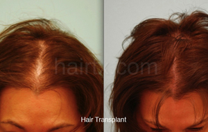 Hair Restoration Before and After Plano Tx