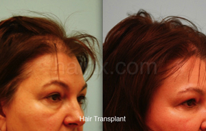 Hair Restoration Before and After Plano Tx