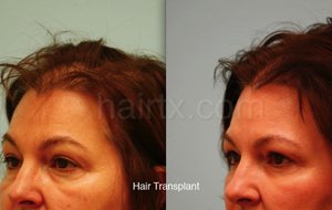 Hair Restoration Before and After Plano Tx