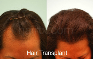 Hair Restoration Before and After Plano Tx