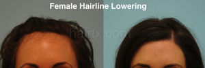 Hair Restoration Before and After Plano Tx