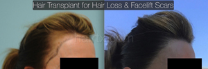 Hair Restoration Before and After Plano Tx