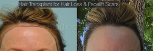 Hair Restoration Before and After Plano Tx