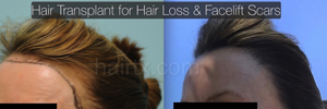 Hair Restoration Before and After Plano Tx