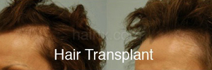 Hair Restoration Before and After Plano Tx