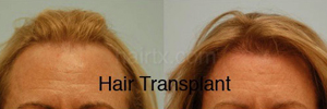 Hair Restoration Before and After Plano Tx