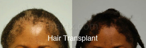 Hair Restoration Before and After Plano Tx