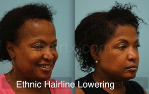 Hair Restoration Before and After Plano Tx