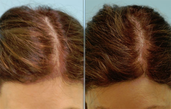 Hair Restoration Before and After Plano Tx