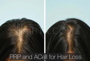 PRP and ACell for Hair Loss Results Dallas