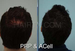 PRP and ACell for Hair Loss Results Dallas