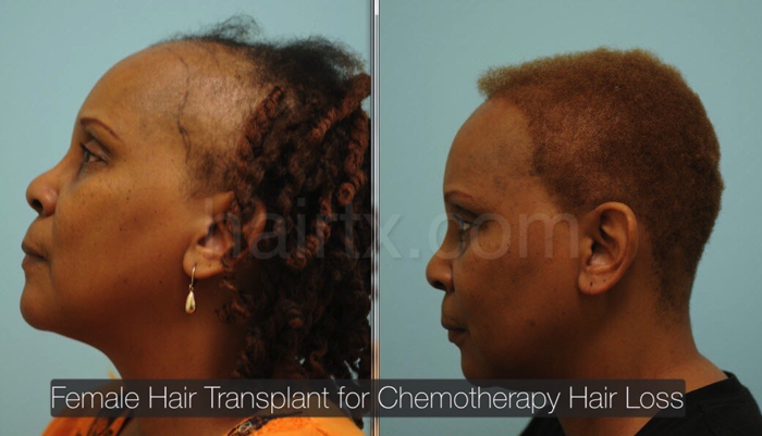 Ethnic Hair Restoration in Dallas Dr. Sam Lam