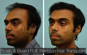 Ethnic Hair Restoration Before and After Photo Plano