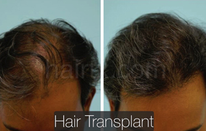 Ethnic Hair Restoration Before and After Photo Plano