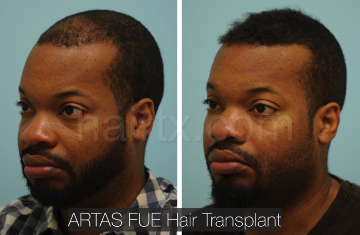Ethnic Hair Restoration Dallas | Ethnic Hair Surgery Plano, Tx