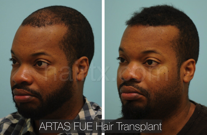 Ethnic Hair Restoration Dallas | Ethnic Hair Surgery Plano, Tx Ethnic Hair Restoration Dallas | Ethnic Hair Surgery Plano, Tx