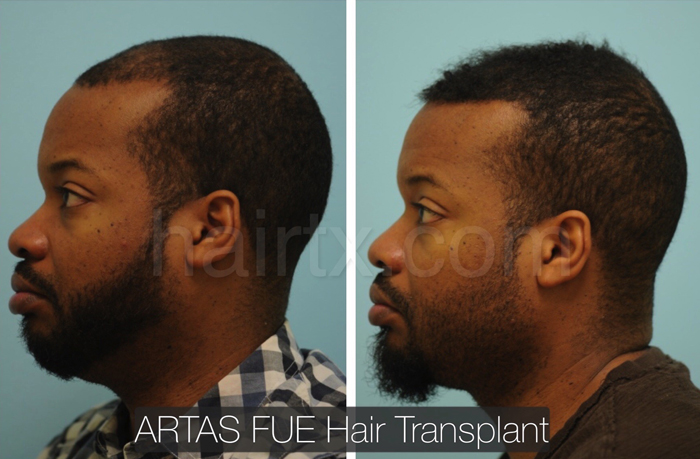 Ethnic Hair Restoration Dallas Ethnic Hair Surgery Plano Tx
