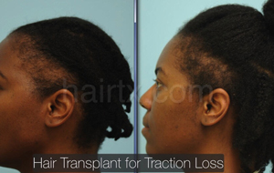 Ethnic Hair Restoration Before and After Photo Plano