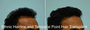 Ethnic Hair Restoration Before and After Photo Plano