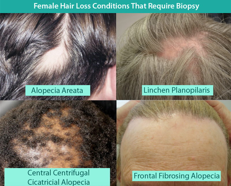 Female Metabolic Evaluation Dallas | Female Hair Loss Plano Tx