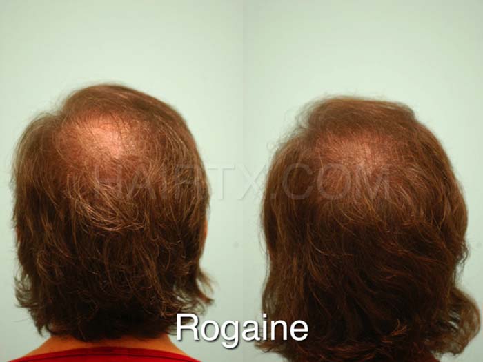 should i stop using minoxidil before hair transplant