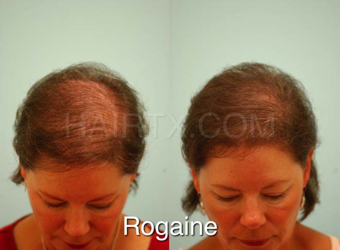 can females use male rogaine