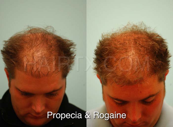 Minoxidil finasterid Switching from