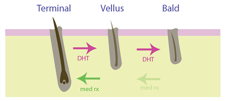 Male Pattern Hair Loss