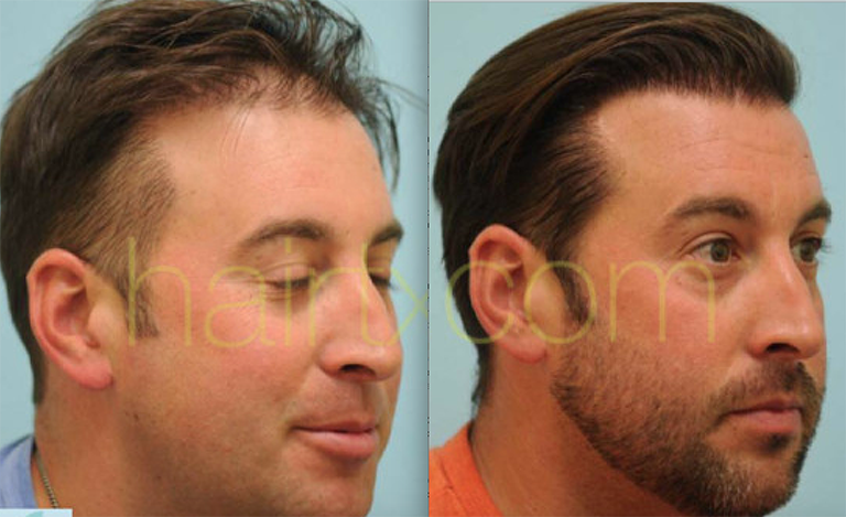 Male Hair Transplant & Hair Restoration in Dallas, Texas