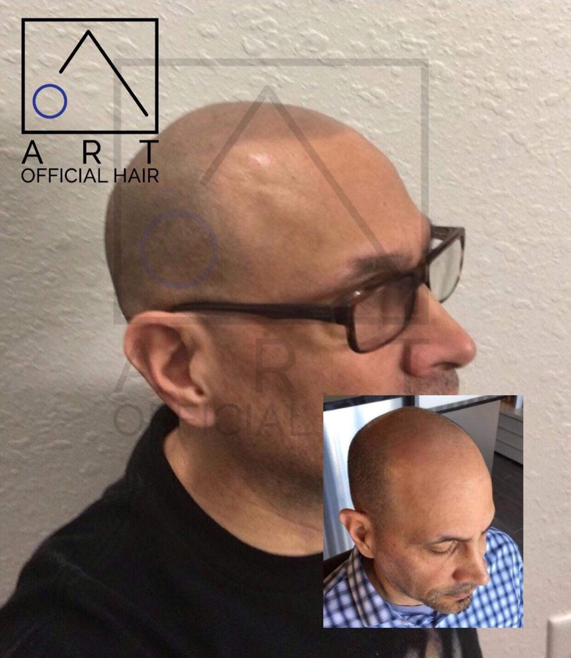 Scalp Micropigmentation (SMP) Before After Photo Dallas