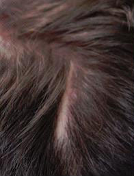 Scalp Micropigmentation (SMP) Before Photo Dallas