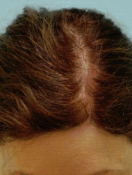 Scalp Micropigmentation (SMP) After Photo Dallas