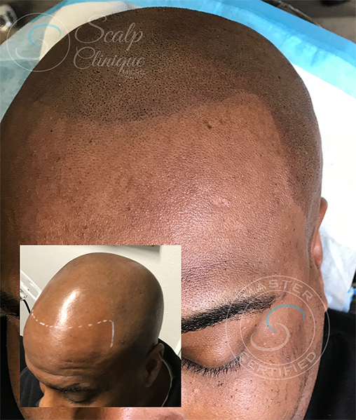 Scalp Micropigmentation (SMP) Before After Photo Dallas