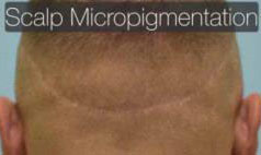 Scalp Micropigmentation (SMP) Before Dallas