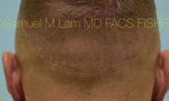 Scalp Micropigmentation (SMP) After Photo Dallas