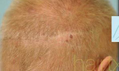 Scalp Micropigmentation (SMP) Before Photo Dallas