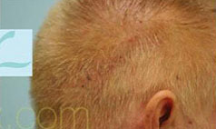 Scalp Micropigmentation (SMP) Results Photo Dallas