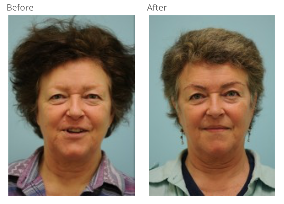 Eyebrow Restoration Dallas | Brow Surgery Information Plano, Tx Eyebrow Restoration Dallas | Brow Surgery Information Plano, Tx