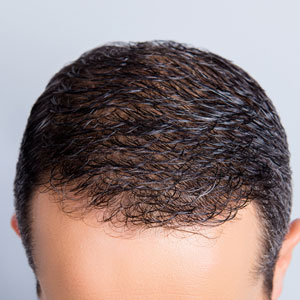 View more Rogaine (Minoxidil) Before & After photos.