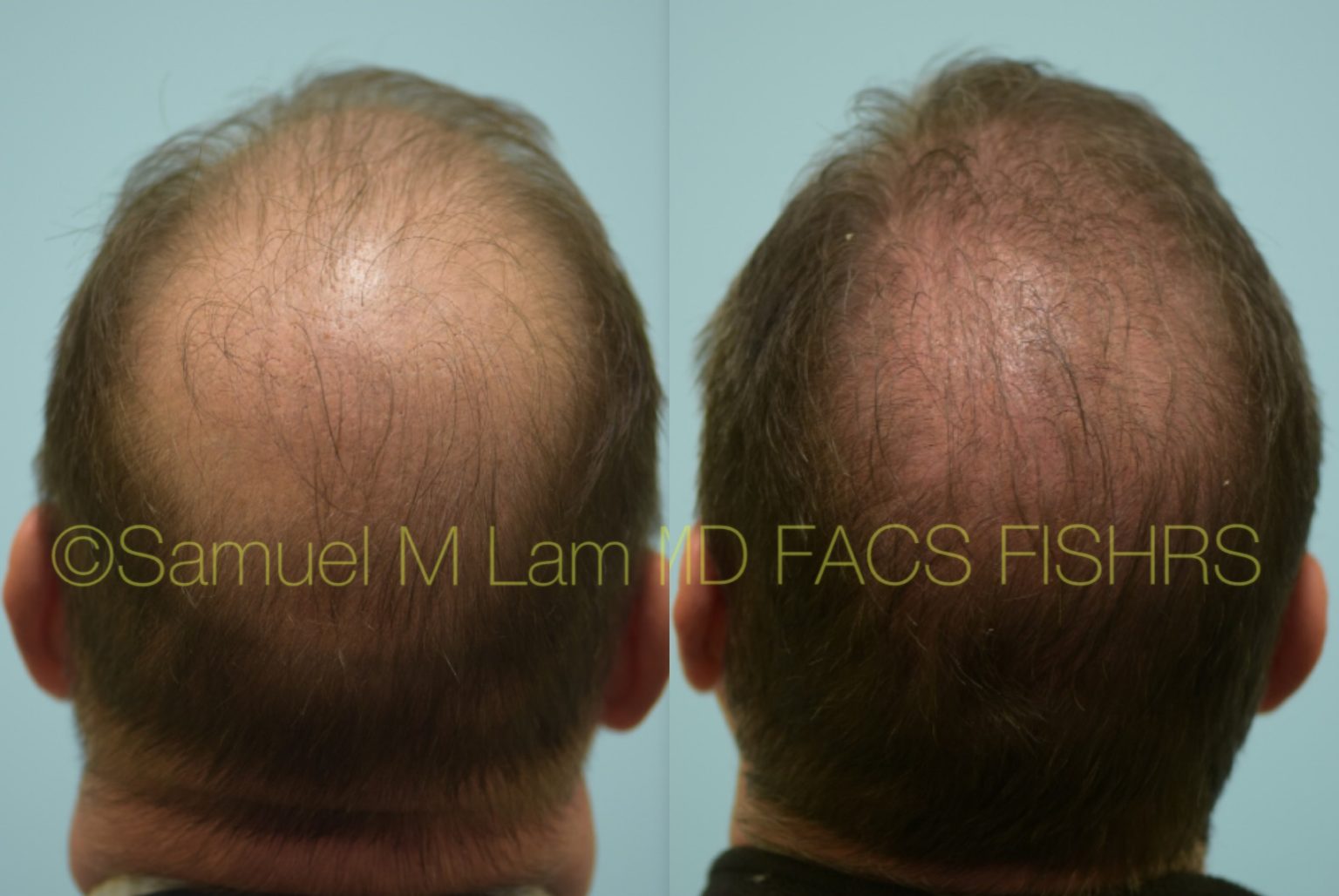 Dallas Finasteride and Minoxidil Before and After Photos Plano