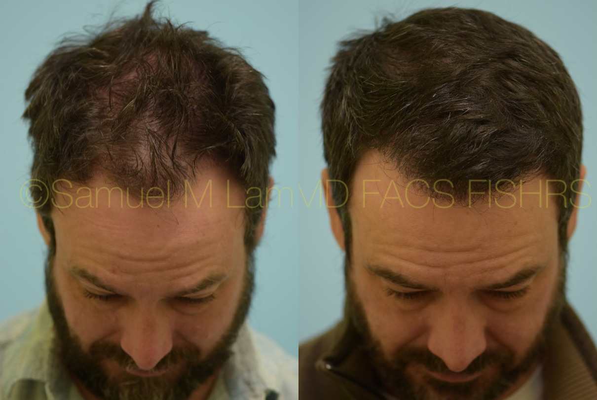 hair restoration before and after photo by Lam's Institute for Hair Restoration