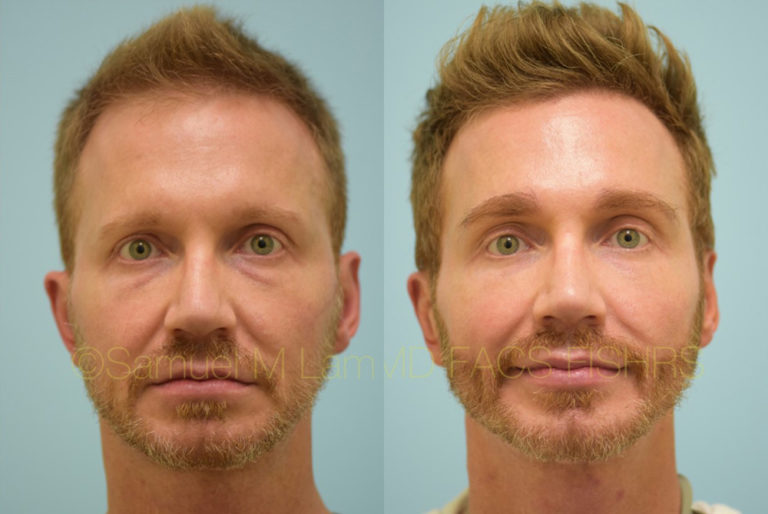 Dallas Eyebrow Hair Restoration Before and After Photos - Plano Plastic Surgery Photo Gallery ...
