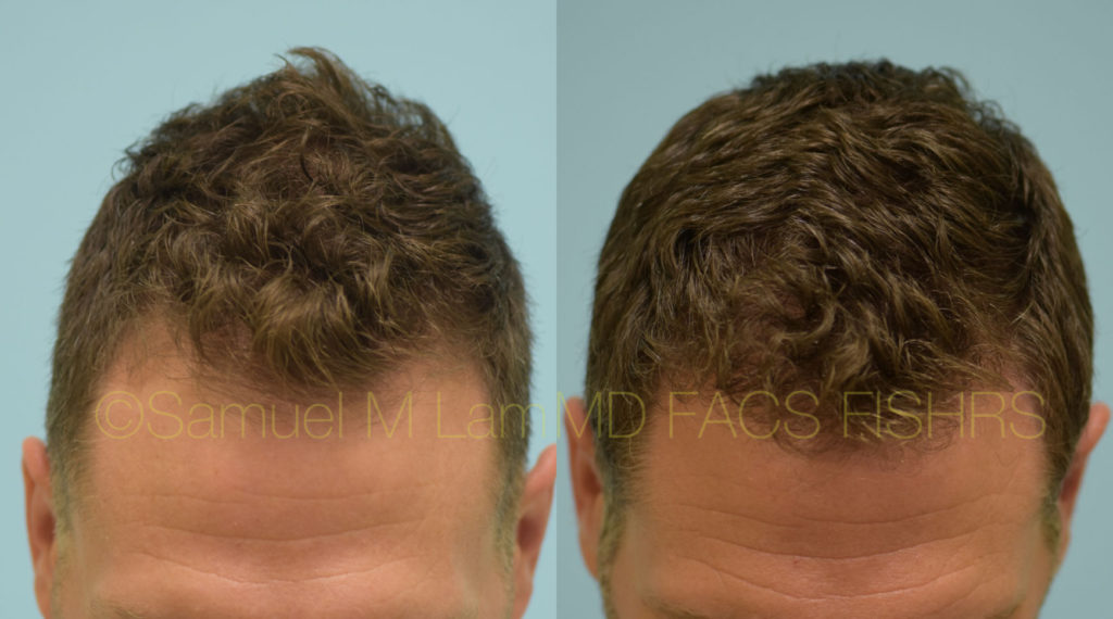 Dallas Finasteride and Minoxidil Before and After Photos Plano