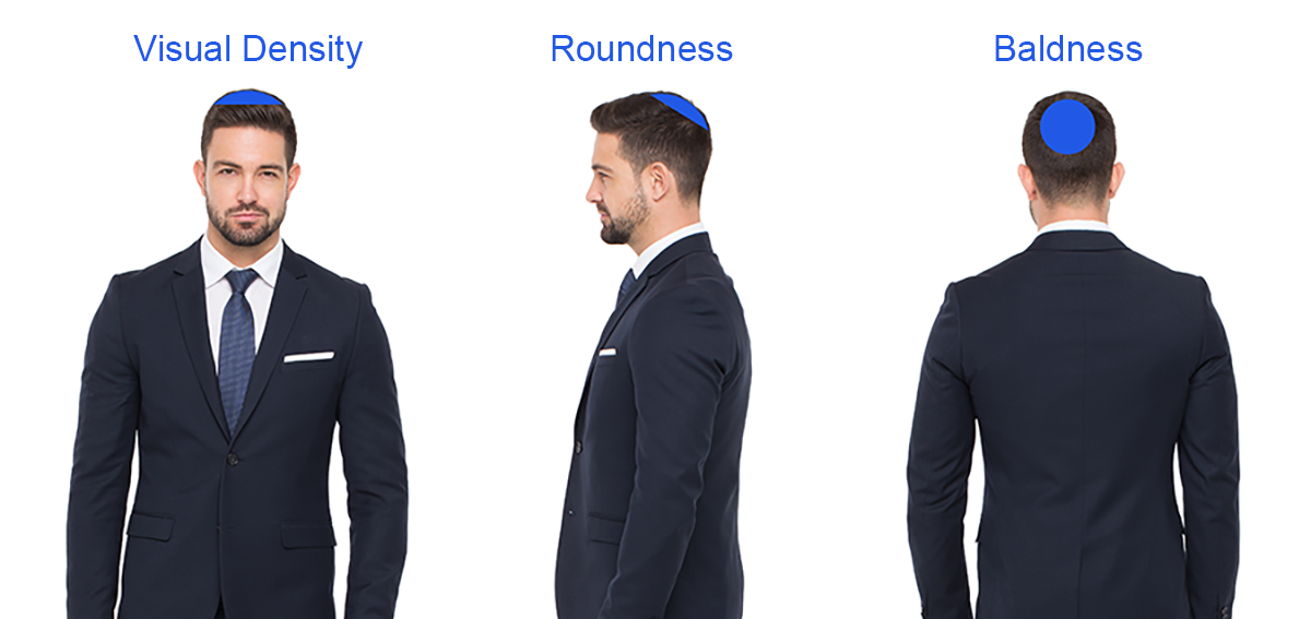 Crown Hair Transplant -1 Young caucasian stylish businessman front side rear view isolate