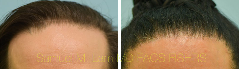 Transgender Hair Transplant Frontal view Before & After Dallas